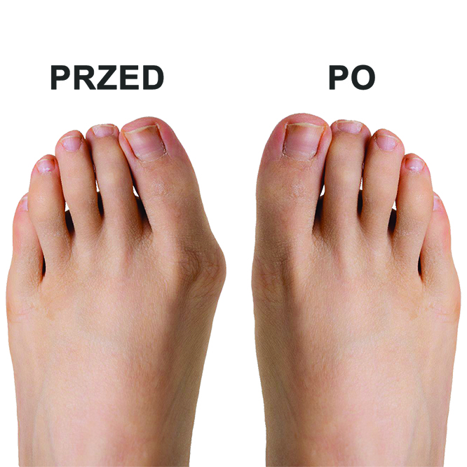 Operacja palucha koślawego (hallux)